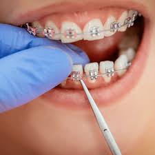 Clips / Braces Treatment Services