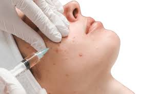 Acne Treatment Services