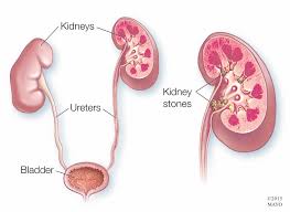Kidney & Bladder Stones URSL, PCNL, RIRS ( Laser Stone Surgery) Services